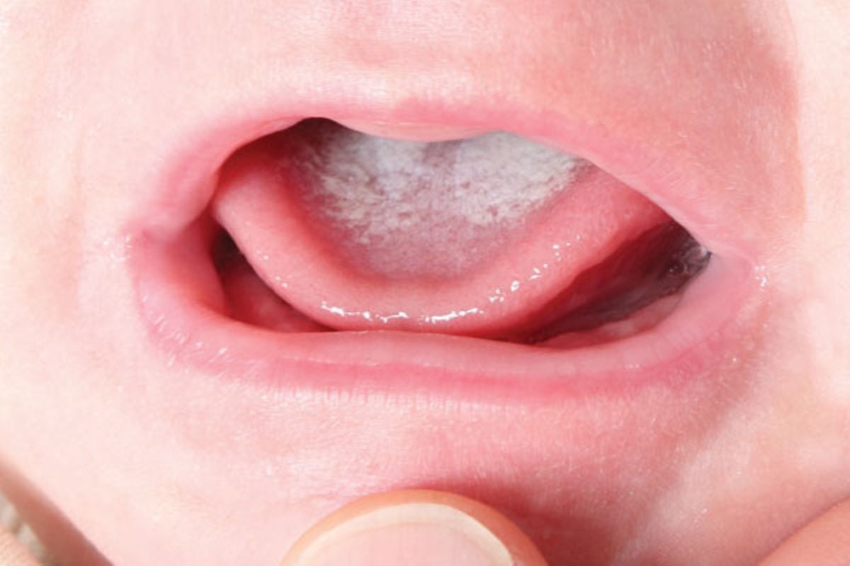 婴儿鹅口疮图片图早期（舌苔厚）-幼儿百科-魔术铺