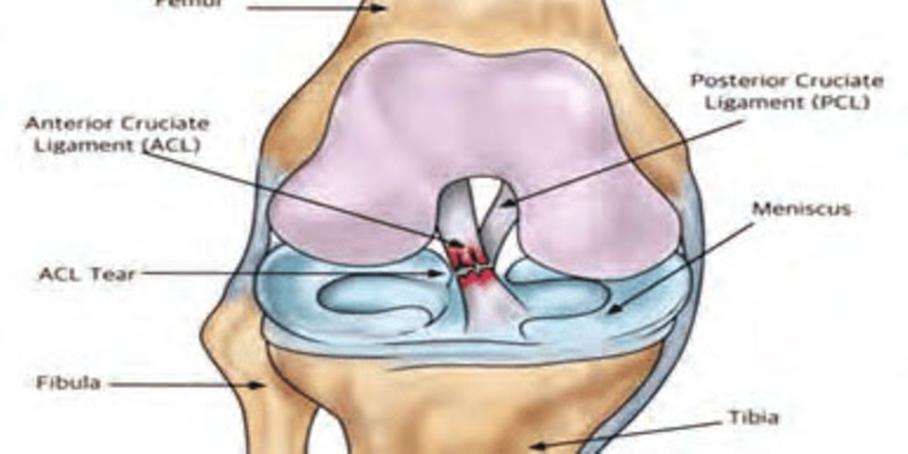 Anterior Cruciate Ligament Injury Can Be Fully Managed With Surgery Nation