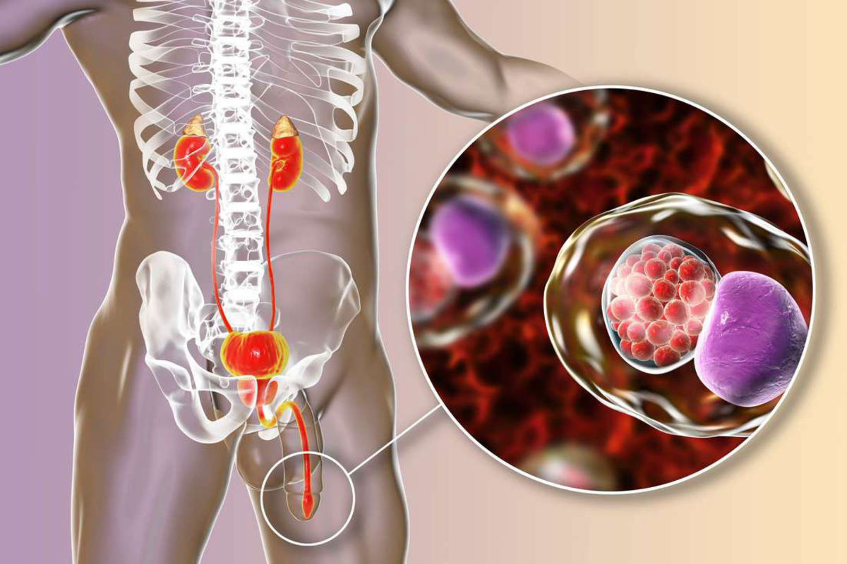 What Std Causes Pain In Testicles