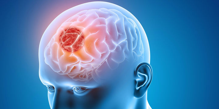 What You Need To Know About Brain Tumours Nation