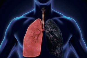 Lung cancer