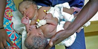 kisii conjoined twins