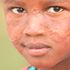 Sharon wanjiku, 7, who is suffering from cutaneous leishmania, at their home in Gitare Village, Gilgil, Nakuru County. 