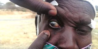 Trachoma-infected eyes.
