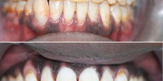Use teeth whitening products as directed.