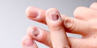 discoloured nails, fungal infection, fingernails