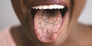 fissured tongue, cracked tongue, tongue health
