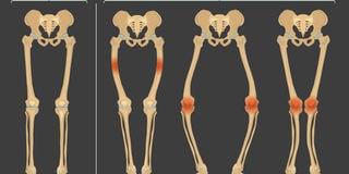 Rickets is a skeletal disorder that causes the softening and weakening of bones in children. 