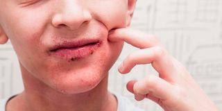 mouth rash, mouth infection, red rash