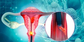 endometriosis, uterus, cancer