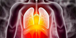 lung infections, lung cancer